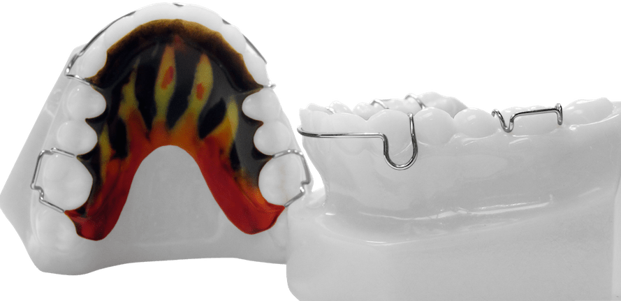 Hawley Retainer With Adams Clasps on First Molars